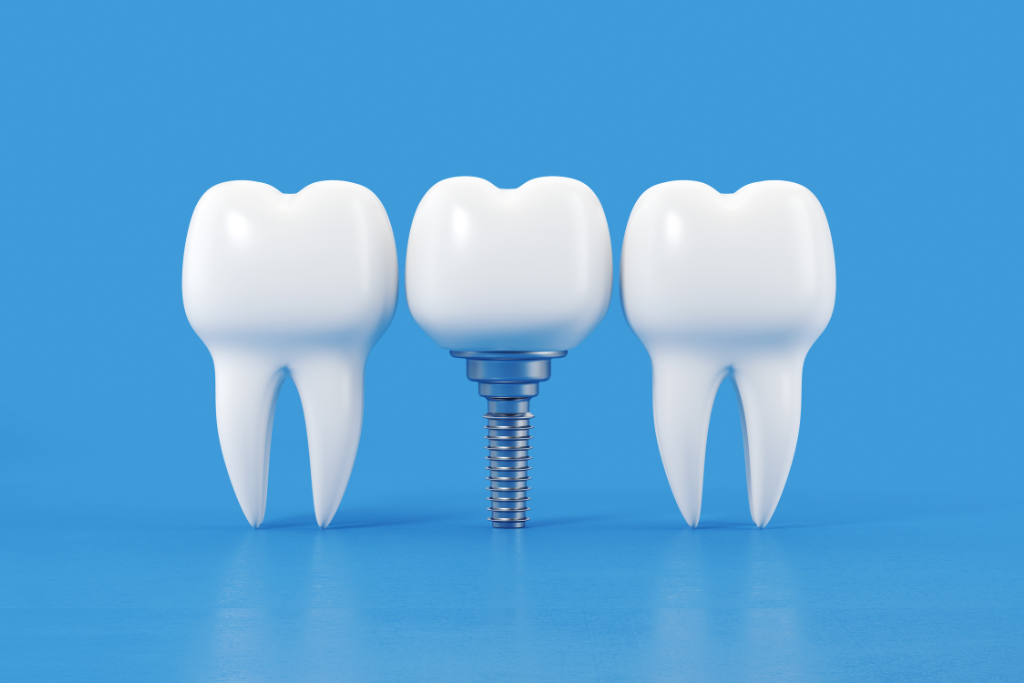 Dental Implants Financing