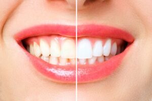 Finance Teeth Whitening