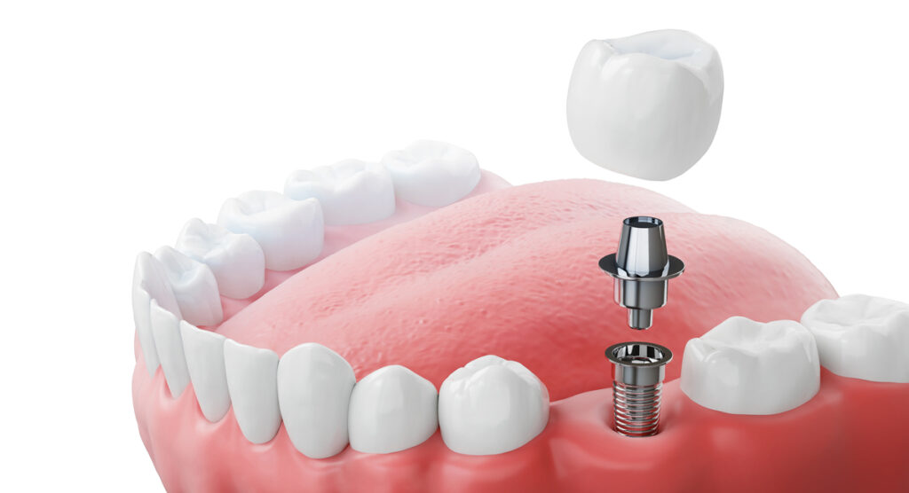 Dental Implants UK Implant diagram