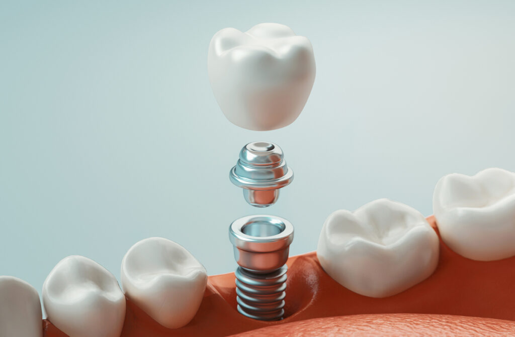 Dental Implants UK Technical Illustration