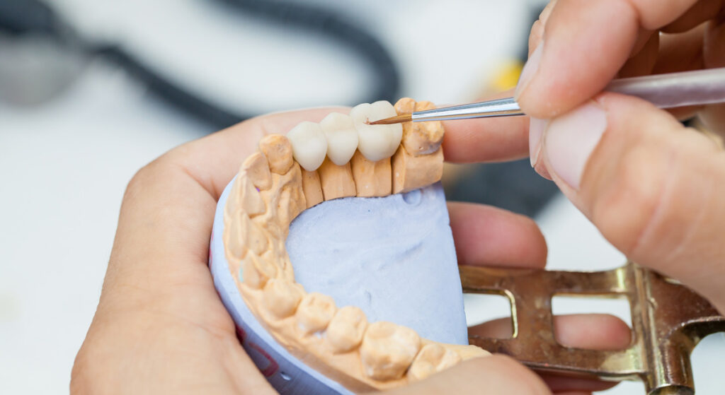 Dental bridges explained