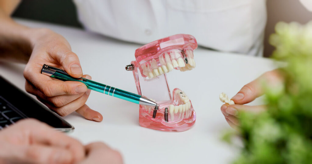 Understanding the cost of dental implants